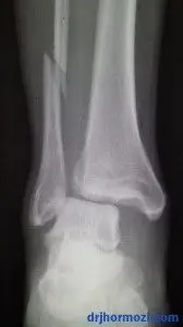 ANKLE FRACTURE