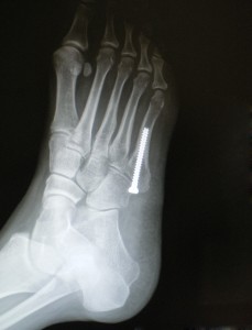 XRay Image After Metetarsal Fracture Surgery on The Right Foot