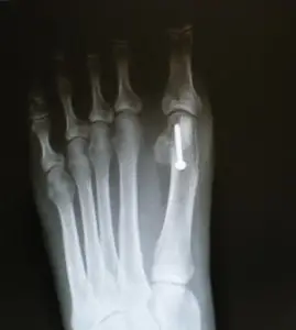 Foot treatment Image