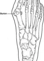 BUNION