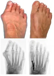 Bunion before and after treatment pictures
