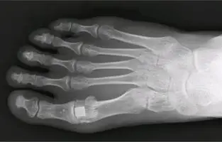 Cartiva treatment in the foot