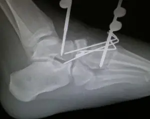 After Foot Fracture Treatment XRay