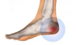 pain in the heel condition illustration