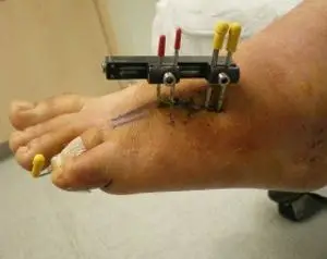 Foot with Ilizarov Fixation Apparatus