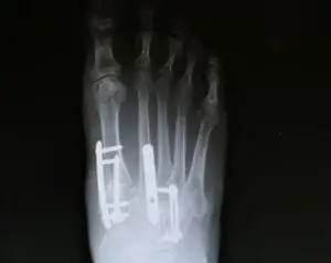 Foot Fracture Treatment