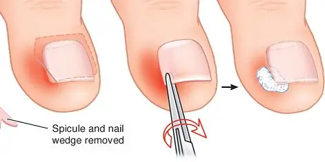 Ingrown Toenail Treatment,Valley Foot and Ankle Center