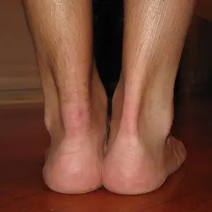 Person with Achilles tendonitis condition