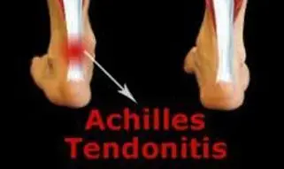 ACHILLES TENDONITIS