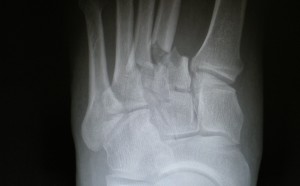XRay Image After Metetarsal Fracture Surgery on The Left Foot
