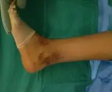 Ankle Arthroscopy treatment image