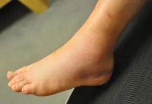 Image of ankle sprain on the left foot
