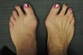 Bunion condition in the feet