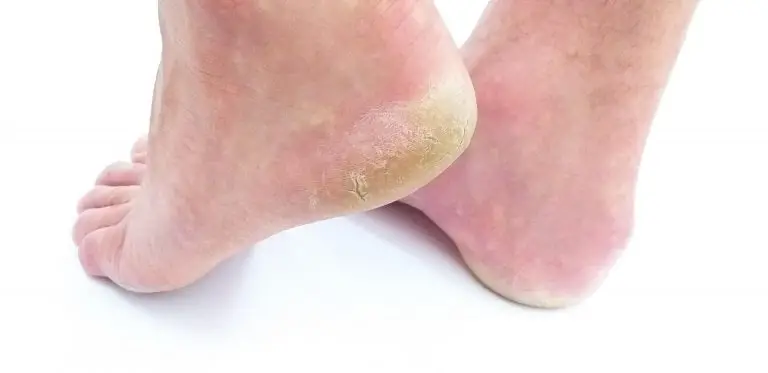 Common Foot Injuries And Their Treatments