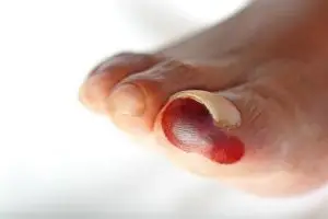 Diabetic peripheral nerve damage in the toe