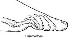 HAMMERTOE TREATMENT