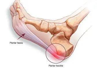 Plantar Fasciitis