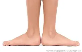 Person with flat feet