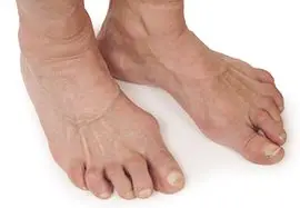 Person with foot arthritis