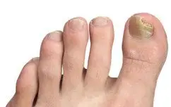 Nails with fungal infection