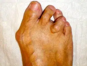 person with hammertoe condition
