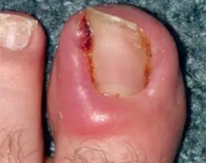 Picture of Ingrown toenail