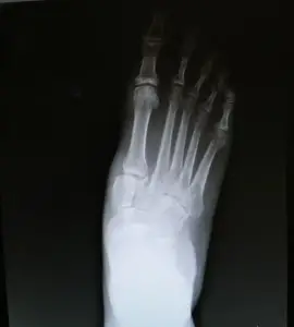 Metatarsal Fracture in the Foot.