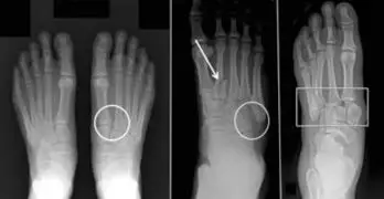 Lisfranc dislocation fracture XRay images