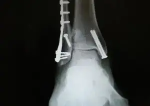 Surgical treatment for acute ankle sprain