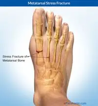 Matatarsal Fracture Image