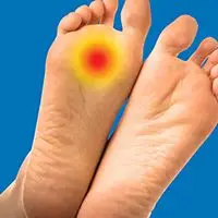Illustration of metatarsalgia in the foot