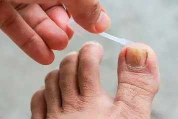 Toenail Fungus Treatment,Valley Foot and Ankle Center