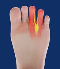 Illustration of Neuroma condition