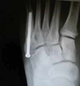 XRay Image After Metetarsal Fracture Surgery on The Left Foot