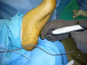 Surgical Treatment of Heel Pain