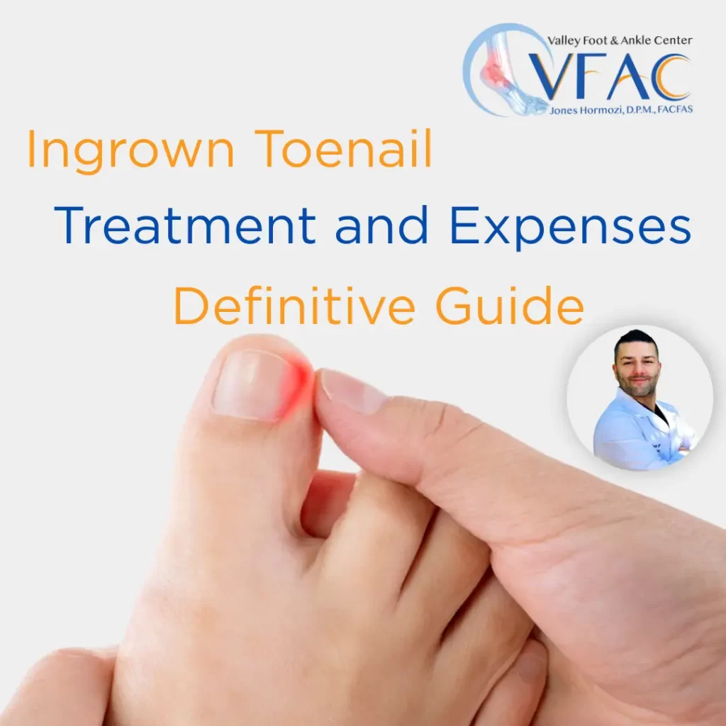 Definitive Guide to Ingrown Toenail Treatment and Expenses