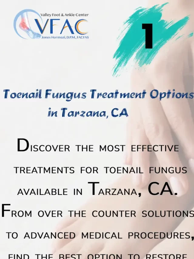 Finding a Toenail Fungus Treatment Specialist in Tarzana CA